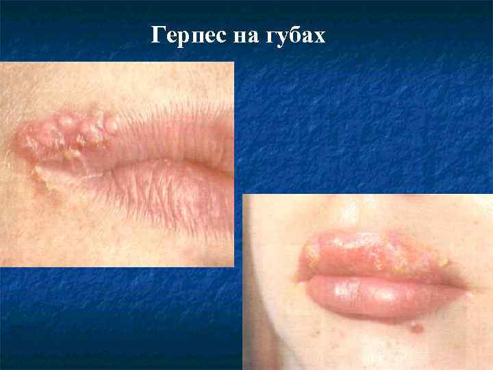 Герпес на губах 