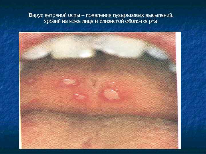 Вирус ветряной оспы – появление пузырьковых высыпаний, эрозий на коже лица и слизистой оболочке