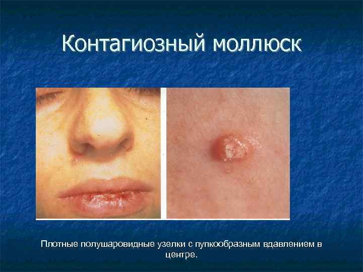Контагиозный моллюск Плотные полушаровидные узелки с пупкообразным вдавлением в центре. 