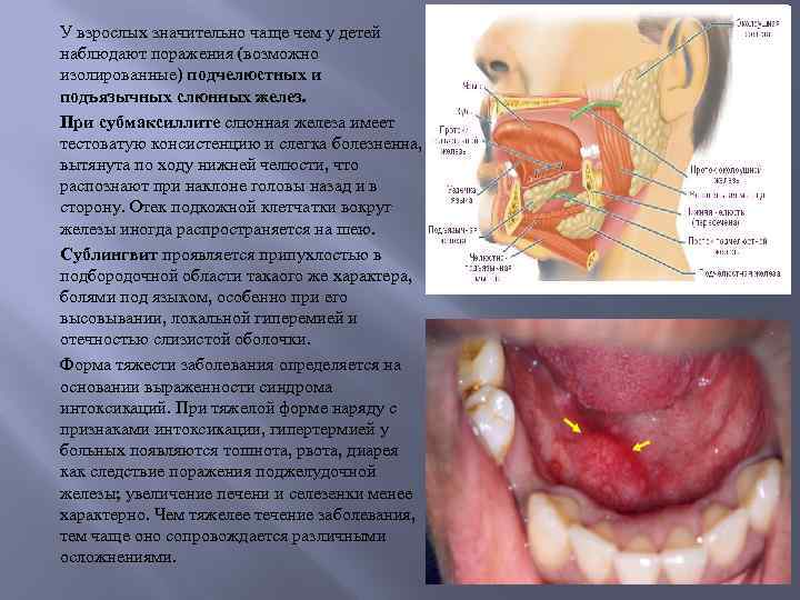 У взрослых значительно чаще чем у детей наблюдают поражения (возможно изолированные) подчелюстных и подъязычных