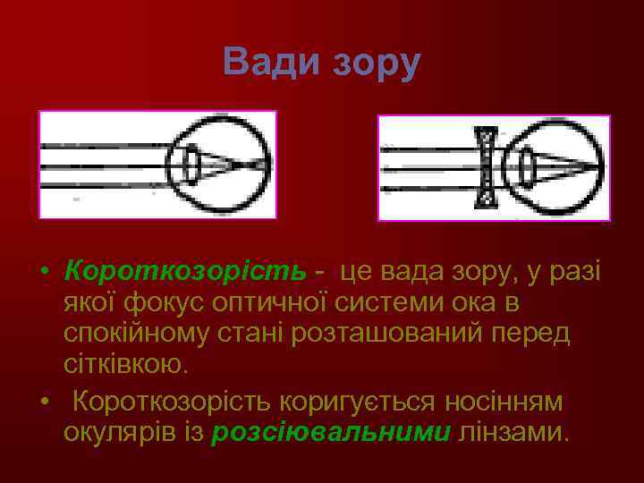 Вади зору • Короткозорість - це вада зору, у разі якої фокус оптичної системи