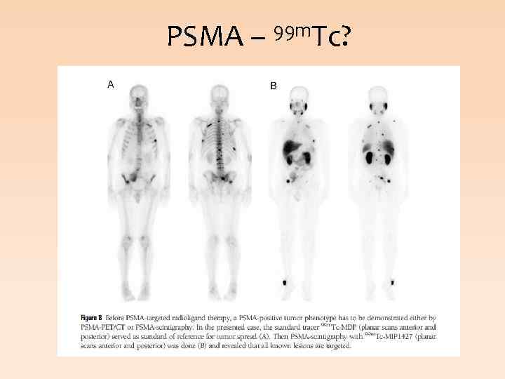 PSMA – 99 m. Tc? 