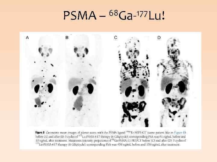 PSMA – 68 Ga-177 Lu! 