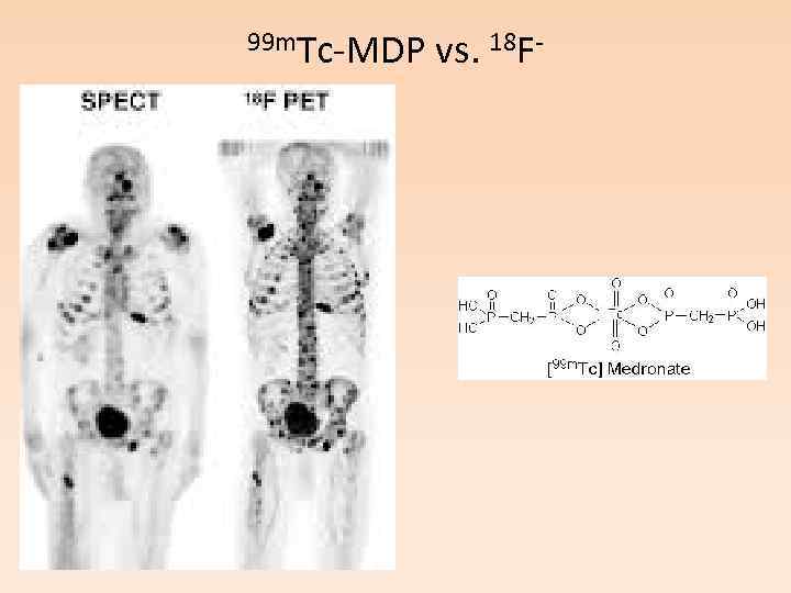 99 m. Tc-MDP vs. 18 F- 