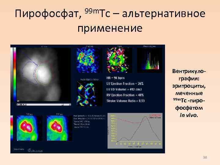 Пирофосфат, 99 m. Тс – альтернативное применение Вентрикулография: эритроциты, меченные 99 m. Tc -пирофосфатом