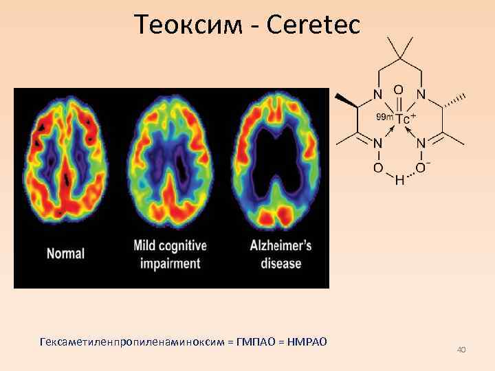 Теоксим - Ceretec Гексаметиленпропиленаминоксим = ГМПАО = HMPAO 40 