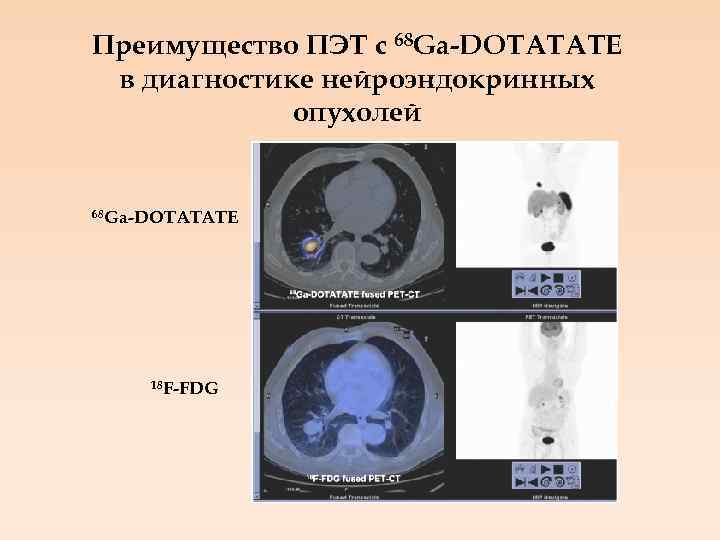 Преимущество ПЭТ с 68 Ga-DOTATATE в диагностике нейроэндокринных опухолей 68 Ga-DOTATATE 18 F-FDG 