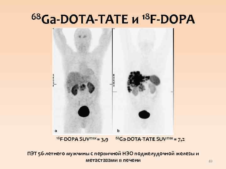 68 Ga-DOTA-TATE и 18 F-DOPA SUVmax = 3, 9 68 Ga-DOTA-TATE SUVmax = 7,