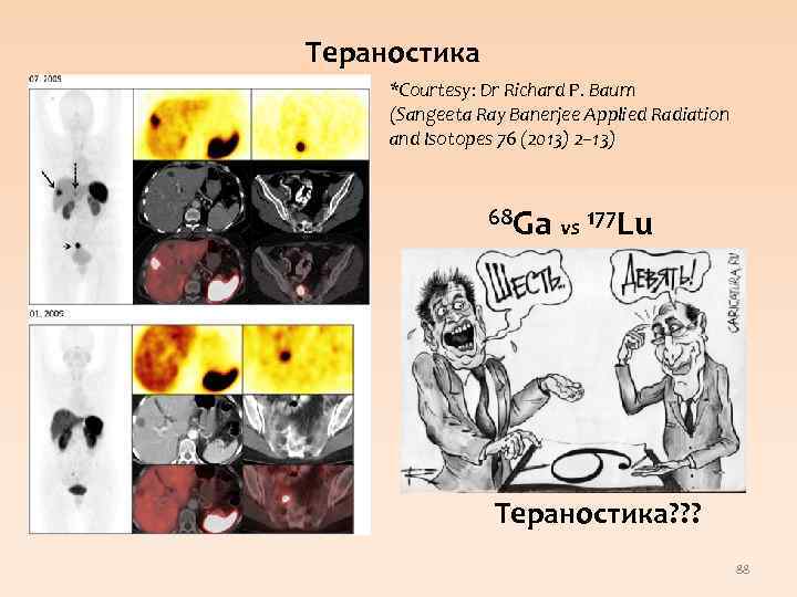 Тераностика • Первичная диагностика с 68 Ga-DOTA-(TOC, TATE, BOC) • Пептидная рецепторная радионуклидная терапия