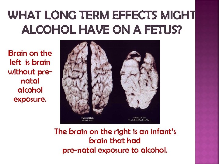 WHAT LONG TERM EFFECTS MIGHT ALCOHOL HAVE ON A FETUS? Brain on the left