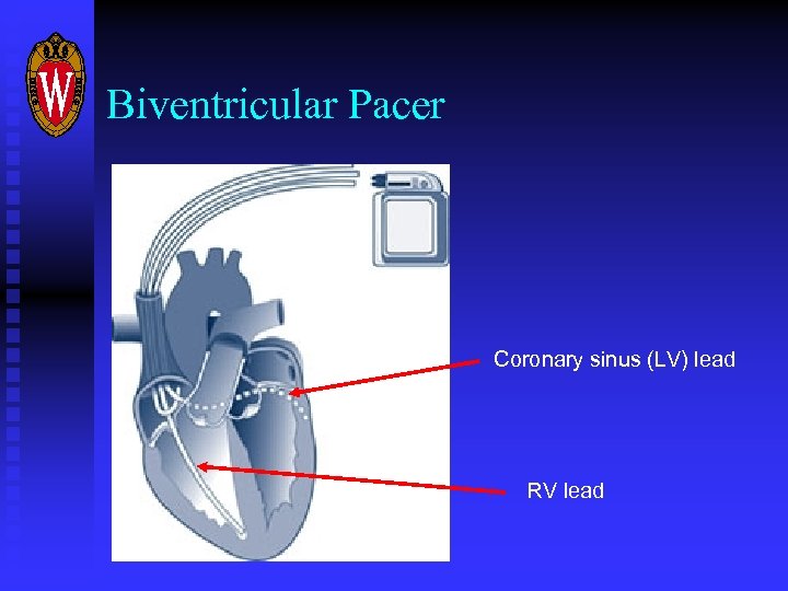 Biventricular Pacer Coronary sinus (LV) lead RV lead 