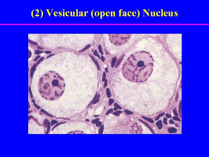 (2) Vesicular (open face) Nucleus 