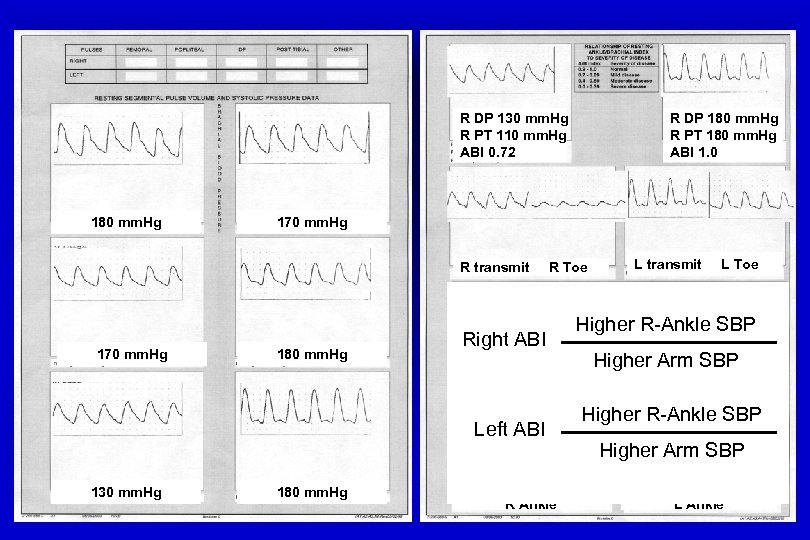 R DP 130 mm. Hg R PT 110 mm. Hg ABI 0. 72 180