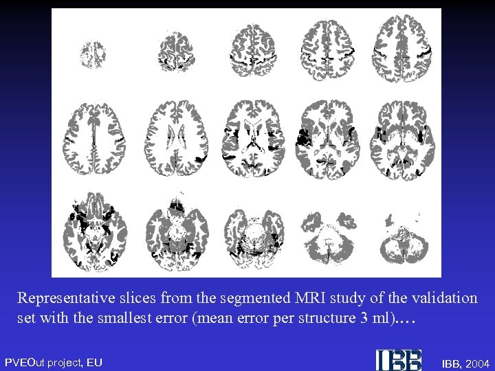 Representative slices from the segmented MRI study of the validation set with the smallest