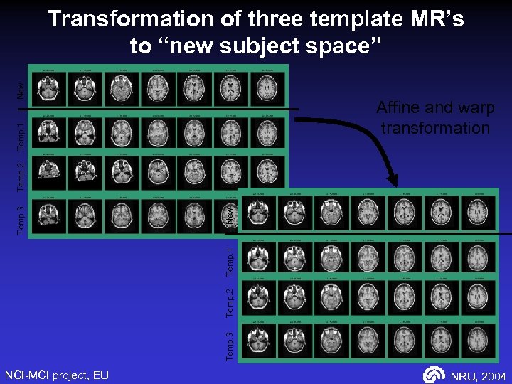 New Transformation of three template MR’s to “new subject space” New Temp. 3 Temp.