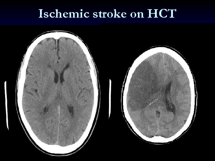 Ischemic stroke on HCT 