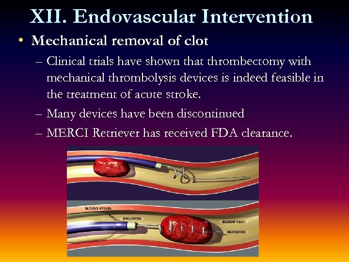 XII. Endovascular Intervention • Mechanical removal of clot – Clinical trials have shown that