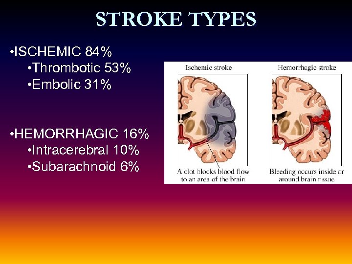 STROKE TYPES • ISCHEMIC 84% • Thrombotic 53% • Embolic 31% • HEMORRHAGIC 16%