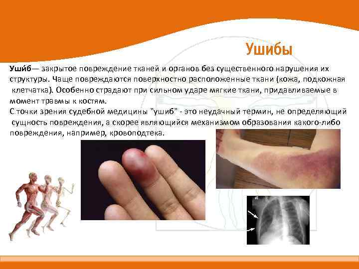 Ушибы Уши б— закрытое повреждение тканей и органов без существенного нарушения их структуры. Чаще