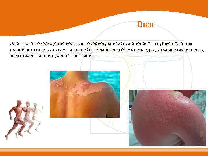 Ожог – это повреждение кожных покровов, слизистых оболочек, глубже лежащих тканей, которое вызывается воздействием