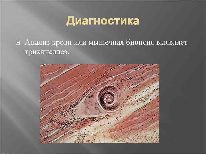 Диагностика Анализ крови или мышечная биопсия выявляет трихинеллез. 