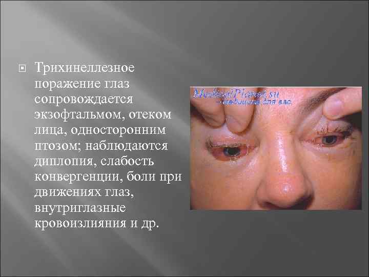  Трихинеллезное поражение глаз сопровождается экзофтальмом, отеком лица, односторонним птозом; наблюдаются диплопия, слабость конвергенции,