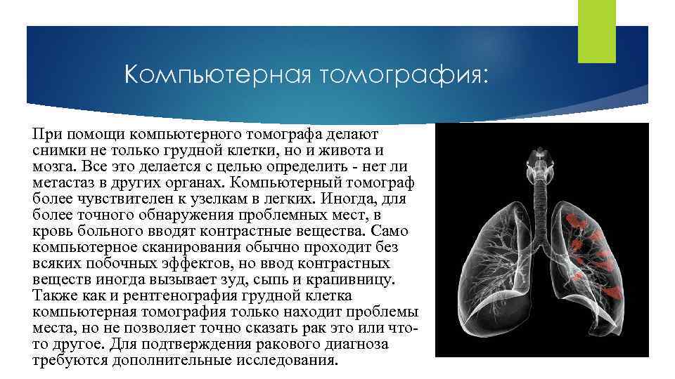 Компьютерная томография: При помощи компьютерного томографа делают снимки не только грудной клетки, но и