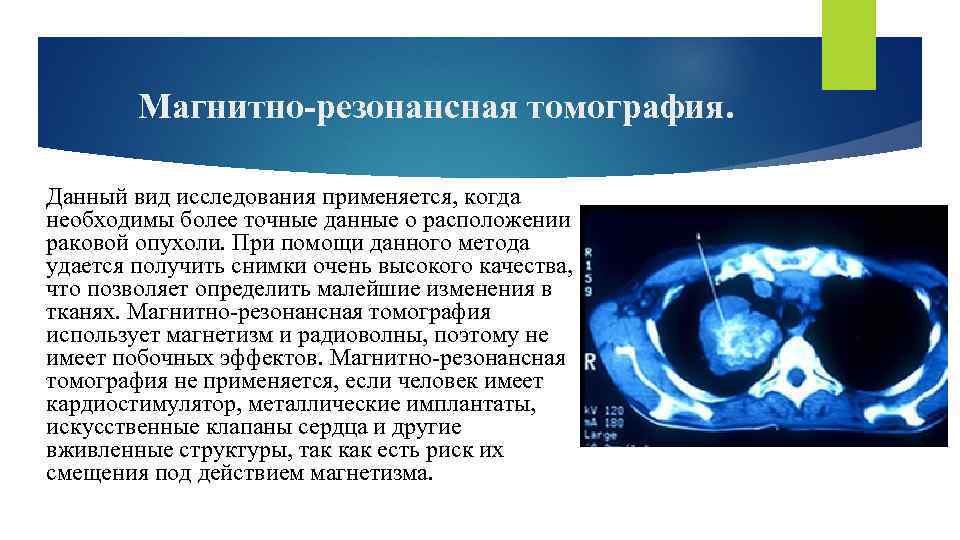 Магнитно-резонансная томография. Данный вид исследования применяется, когда необходимы более точные данные о расположении раковой