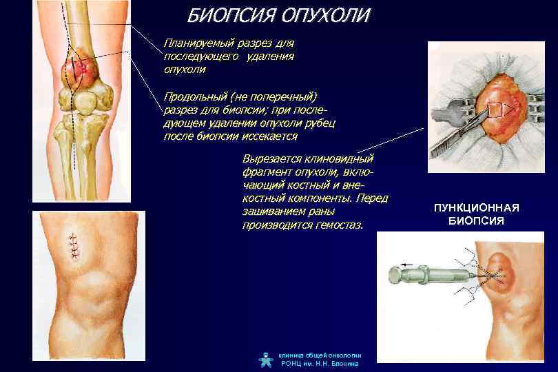 БИОПСИЯ ОПУХОЛИ Планируемый разрез для последующего удаления опухоли Продольный (не поперечный) разрез для биопсии;