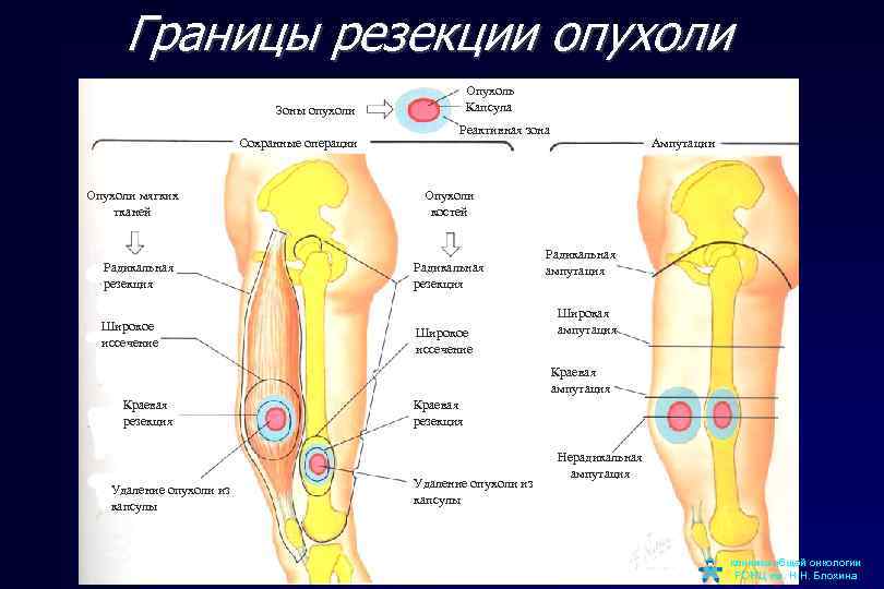 Границы резекции опухоли Опухоль Капсула Зоны опухоли Сохранные операции Опухоли мягких тканей Радикальная резекция