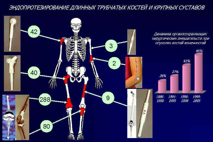 ЭНДОПРОТЕЗИРОВАНИЕ ДЛИННЫХ ТРУБЧАТЫХ КОСТЕЙ И КРУПНЫХ СУСТАВОВ 42 3 2 40 288 80 9