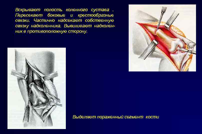 Вскрывают полость коленного сустава. Пересекают боковые и крестообразные связки. Частично надсекают собственную связку надколенника.