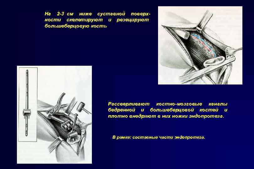 На 2 -3 см ниже суставной поверхности скелетируют и резецируют большеберцовую кость Рассверливают костно-мозговые