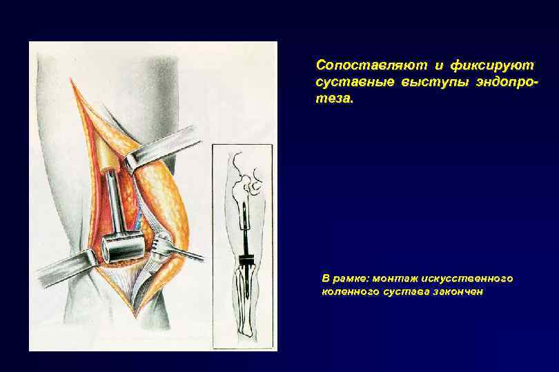 Сопоставляют и фиксируют суставные выступы эндопротеза. В рамке: монтаж искусственного коленного сустава закончен 