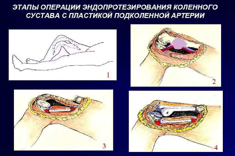 ЭТАПЫ ОПЕРАЦИИ ЭНДОПРОТЕЗИРОВАНИЯ КОЛЕННОГО СУСТАВА С ПЛАСТИКОЙ ПОДКОЛЕННОЙ АРТЕРИИ 1 3 2 4 