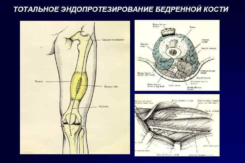 ТОТАЛЬНОЕ ЭНДОПРОТЕЗИРОВАНИЕ БЕДРЕННОЙ КОСТИ 