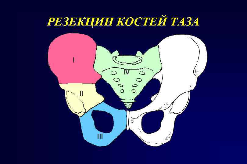 РЕЗЕКЦИИ КОСТЕЙ ТАЗА I IV II III 