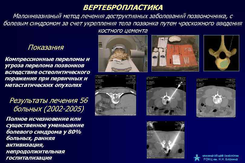 ВЕРТЕБРОПЛАСТИКА Малоинвазивный метод лечения деструктивных заболеваний позвоночника, с болевым синдромом за счет укрепления тела