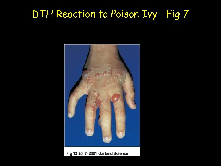 DTH Reaction to Poison Ivy Fig 7 
