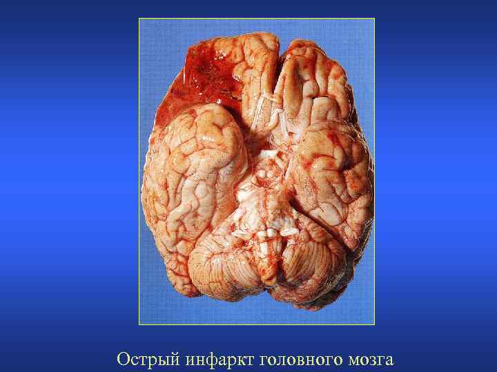 Острый инфаркт головного мозга 