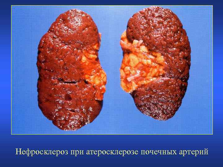 Нефросклероз при атеросклерозе почечных артерий 