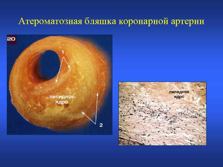 Атероматозная бляшка коронарной артерии 