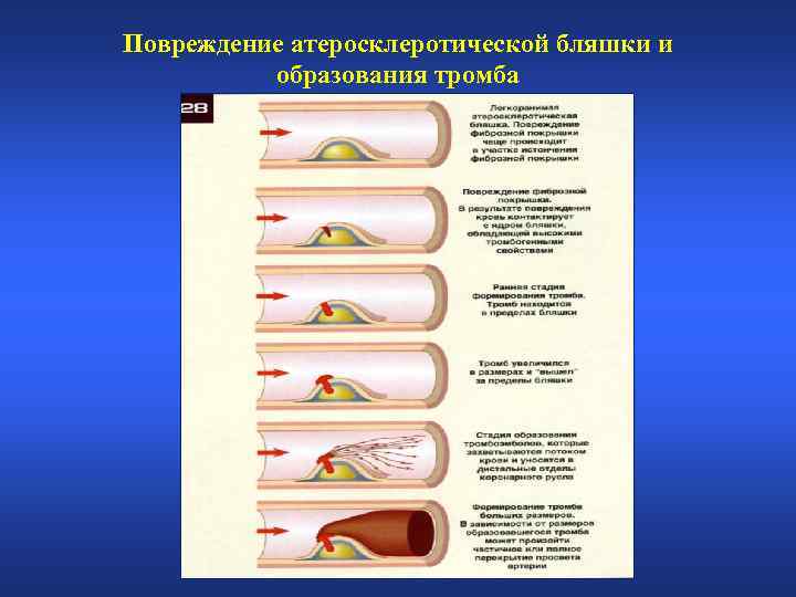 Повреждение атеросклеротической бляшки и образования тромба 