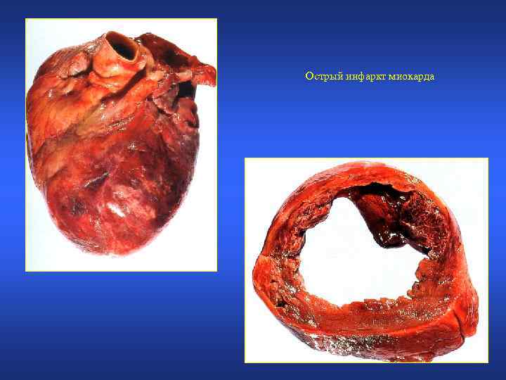 Острый инфаркт миокарда 