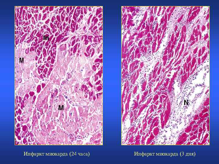 Инфаркт миокарда (24 часа) Инфаркт миокарда (3 дня) 