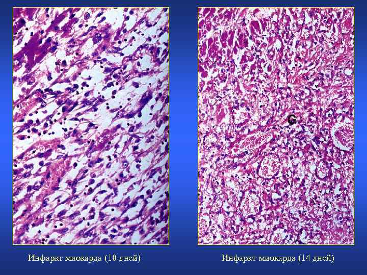 Инфаркт миокарда (10 дней) Инфаркт миокарда (14 дней) 