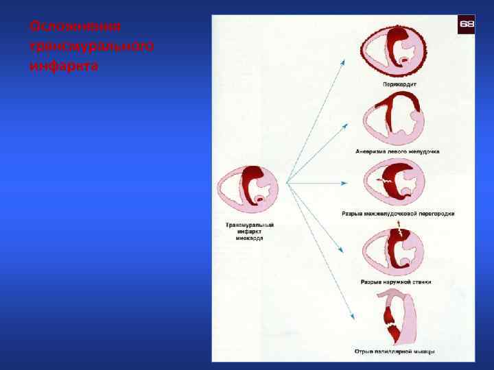 Осложнения трансмурального инфаркта 