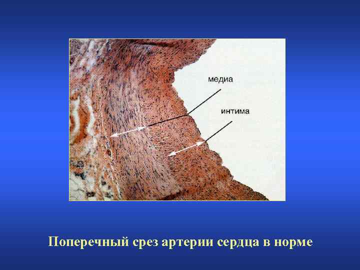 Поперечный срез артерии сердца в норме 