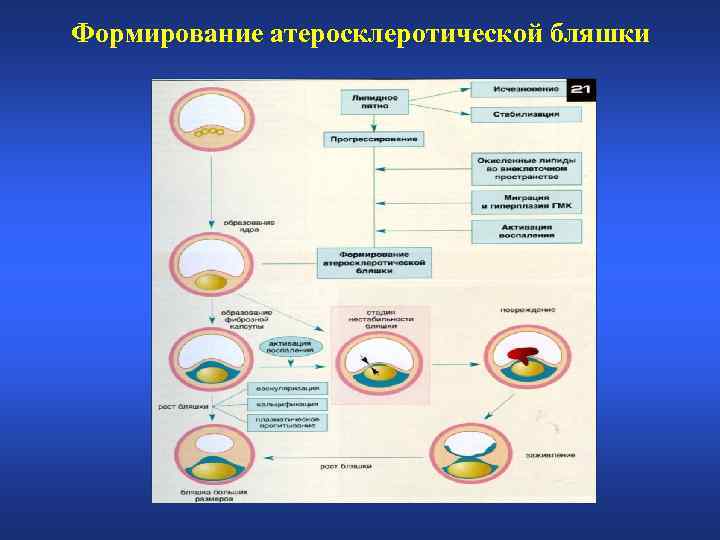 Формирование атеросклеротической бляшки 