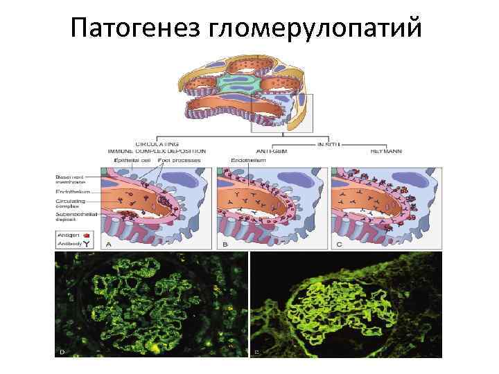 Патогенез гломерулопатий 